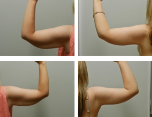 Can You Really Get Rid of Flabby Arms?