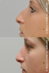 a woman's nose before and after rhinoplasty surgery