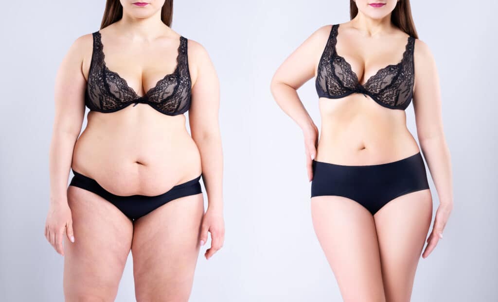 Before and after tummy tuck in Oxon Hill, MD