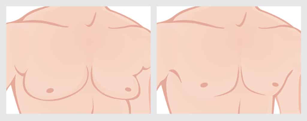 Before and after male breast reduction surgery in Oxon Hill