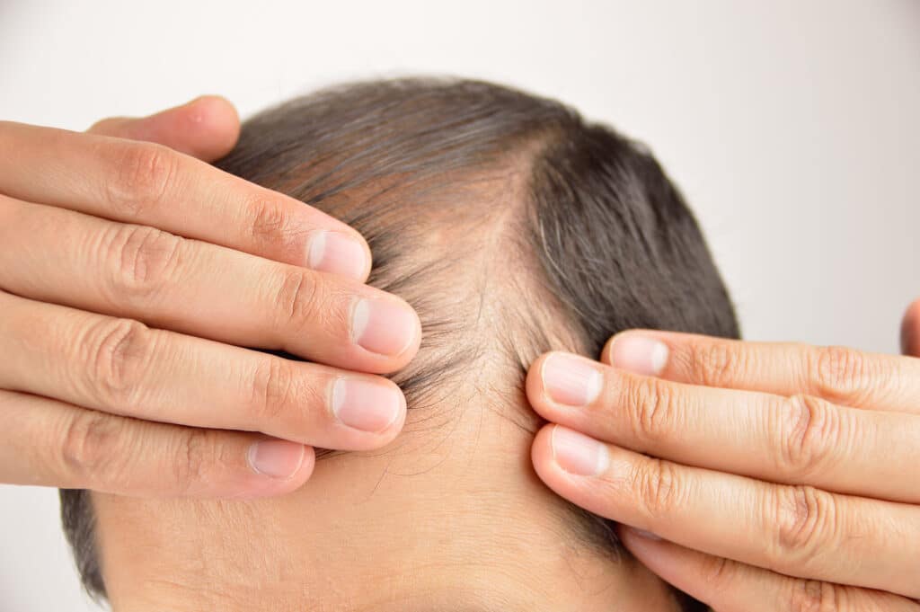Man with thinning hair in Oxon Hill, MD