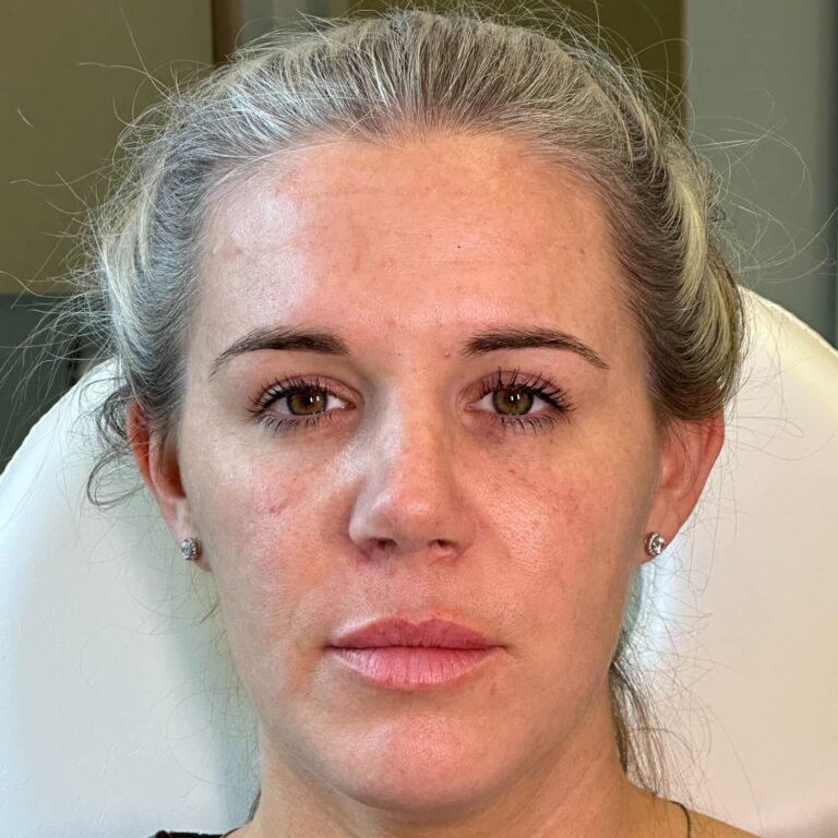 After Image: Rhinoplasty with Alarplasty (nostril narrowing) - front