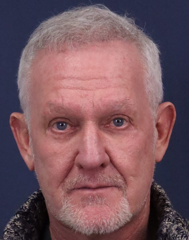 After Image: Lower Eyelid Lift w/ Fat Transposition & Lid Tightening, Facial Fat Grafting - front