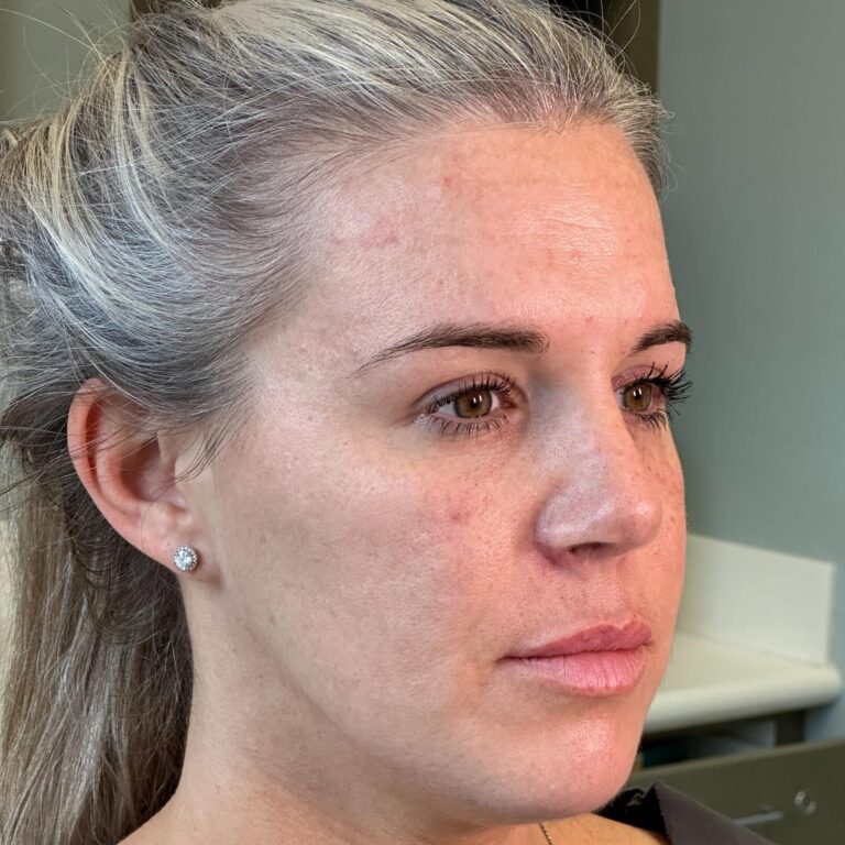 After Image: Rhinoplasty with Alarplasty (nostril narrowing) - right-side