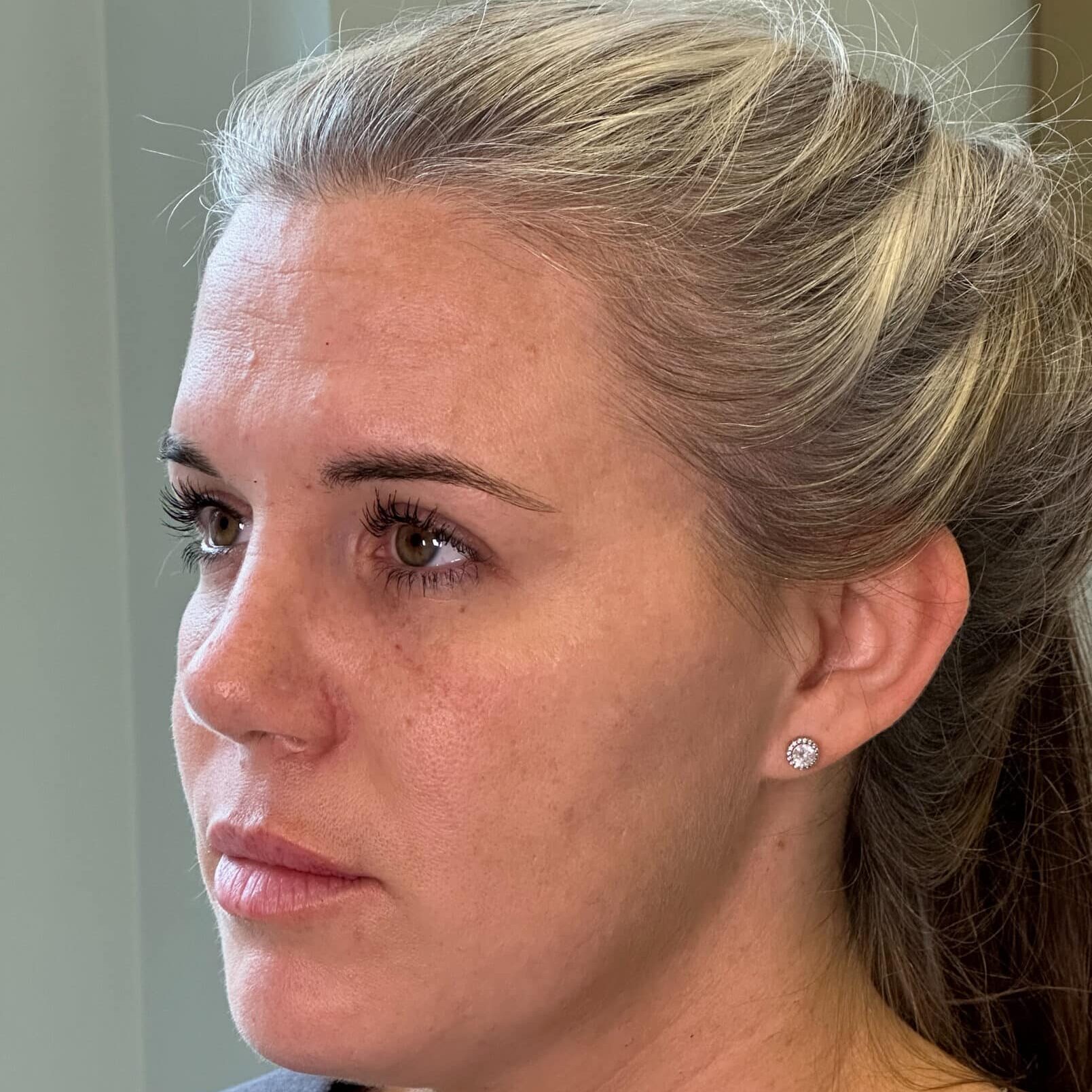 After Image: Rhinoplasty with Alarplasty (3 months post-op) - front
