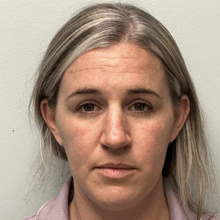 Before Image: Rhinoplasty with Alarplasty (nostril narrowing) - front
