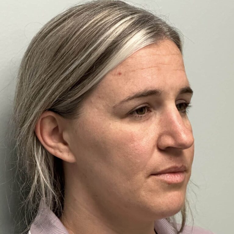 Before Image: Rhinoplasty with Alarplasty (nostril narrowing) - right-side