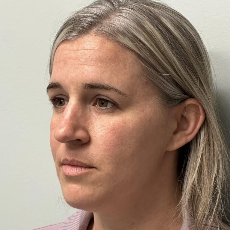 Before Image: Rhinoplasty with Alarplasty (nostril narrowing) - front