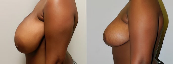 before and after Breast Reduction Alexandria VA