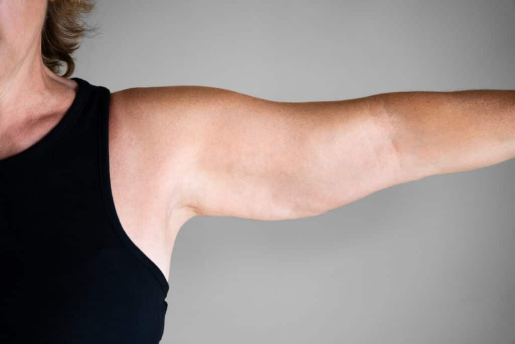 Woman holding up arm with some sagging skin to be addressed with an arm lift or liposuction