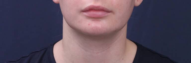 After Image: Submental (chin) Liposuction and Facial Contouring - front