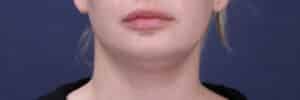 Before Image: Submental (chin) Liposuction and Facial Contouring