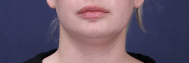 Before Image: Submental (chin) Liposuction and Facial Contouring - front