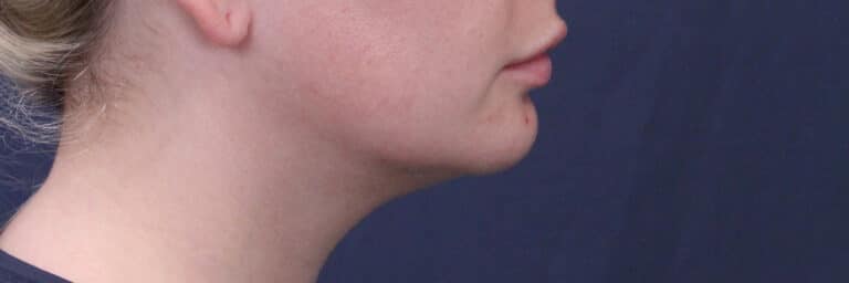 After Image: Submental (chin) Liposuction and Facial Contouring - right-side