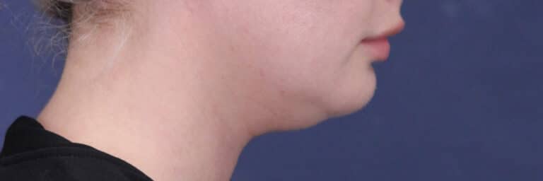 Before Image: Submental (chin) Liposuction and Facial Contouring - right-side