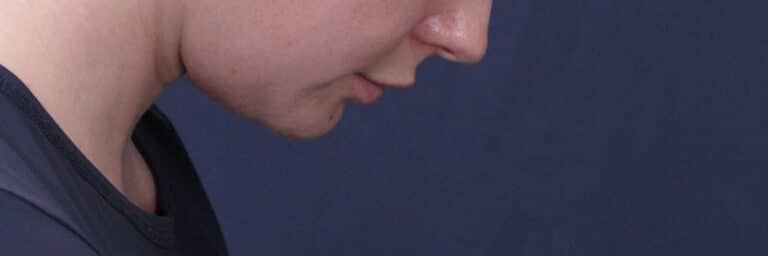 After Image: Submental (chin) Liposuction and Facial Contouring - right-side