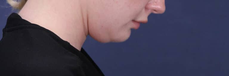 Before Image: Submental (chin) Liposuction and Facial Contouring - right-side