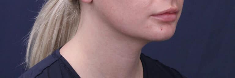 After Image: Submental (chin) Liposuction and Facial Contouring - right-front-oblique