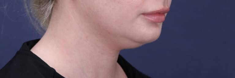 Before Image: Submental (chin) Liposuction and Facial Contouring - right-front-oblique