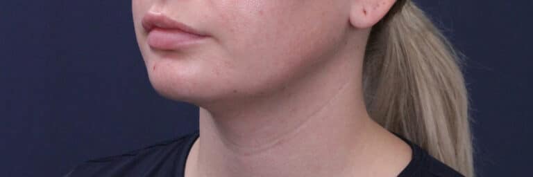 After Image: Submental (chin) Liposuction and Facial Contouring - left-front-oblique