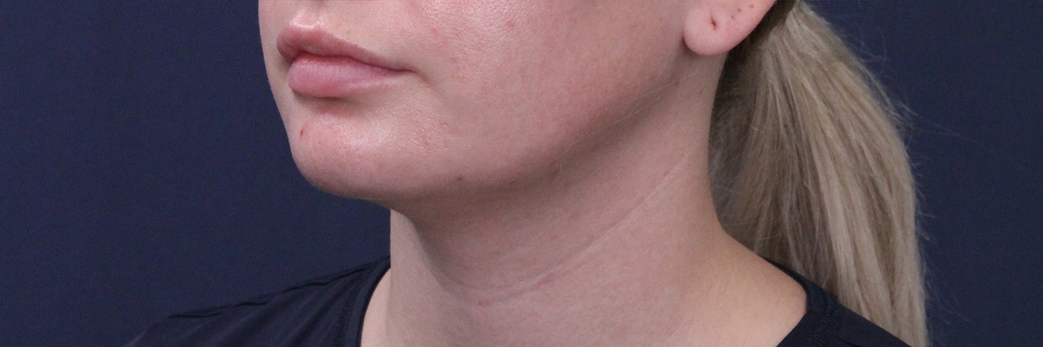 After Image: Submental Liposuction and Facial Contouring - left-front-oblique