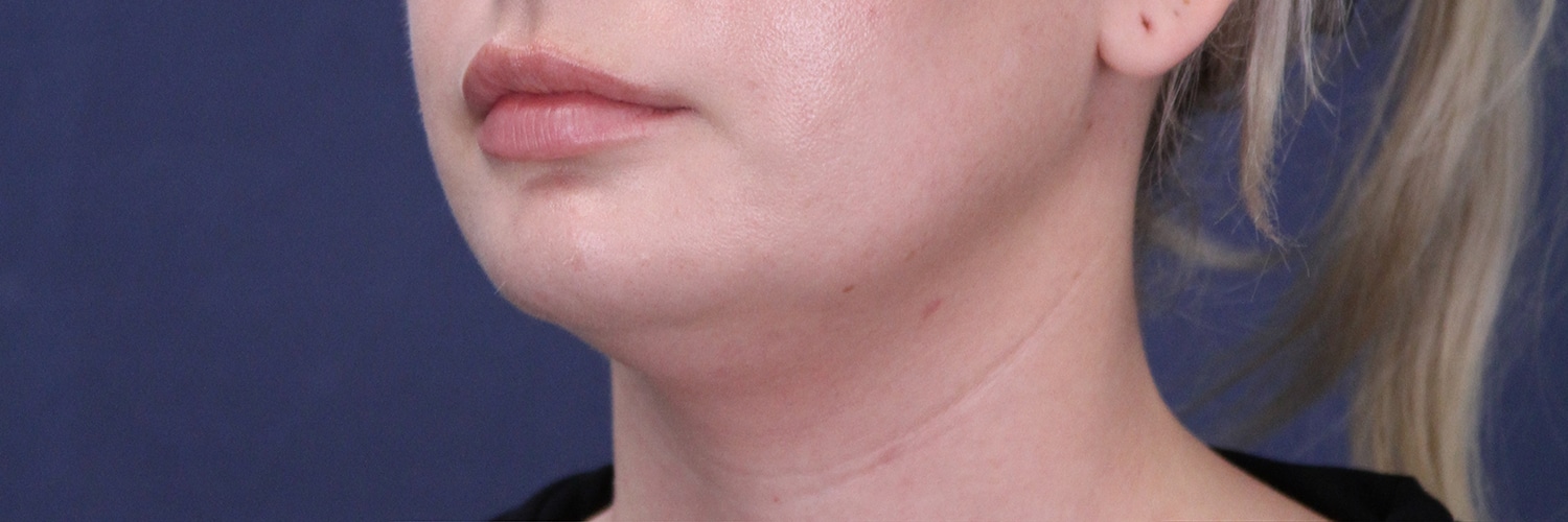 Before Image: Submental Liposuction and Facial Contouring - left-front-oblique