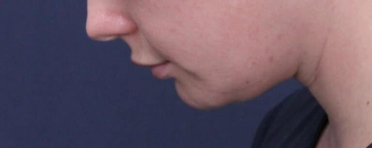 After Image: Submental (chin) Liposuction and Facial Contouring - left-side
