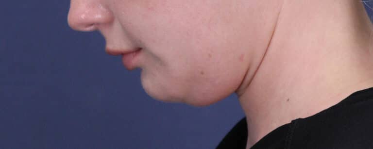 Before Image: Submental (chin) Liposuction and Facial Contouring - left-side