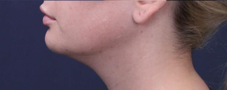 After Image: Submental (chin) Liposuction and Facial Contouring - left-side