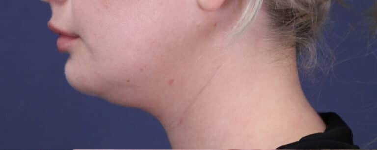 Before Image: Submental (chin) Liposuction and Facial Contouring - left-side