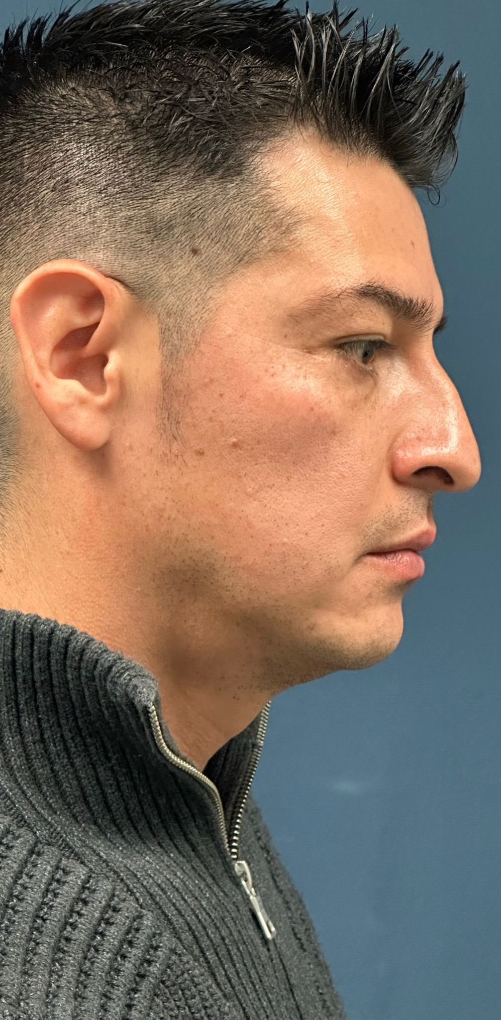 Before Image: Rhinoplasty with Nostril Narrowing and Upper Eyelid Lift - front