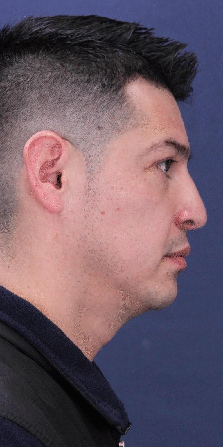 After Image: Rhinoplasty with Nostril Narrowing and Upper Eyelid Lift - front
