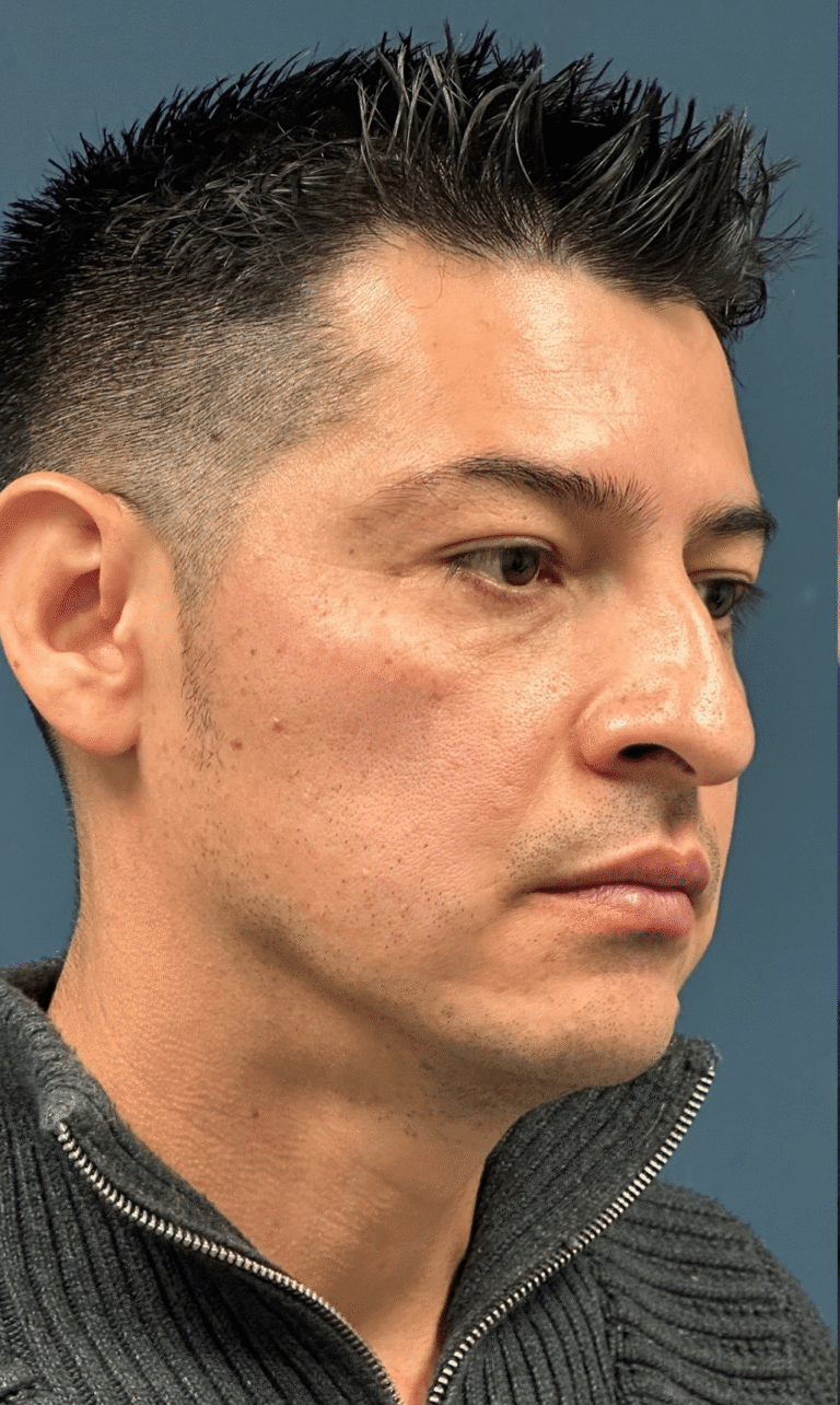 Before Image: Rhinoplasty with Nostril Narrowing and Upper Eyelid Lift - front