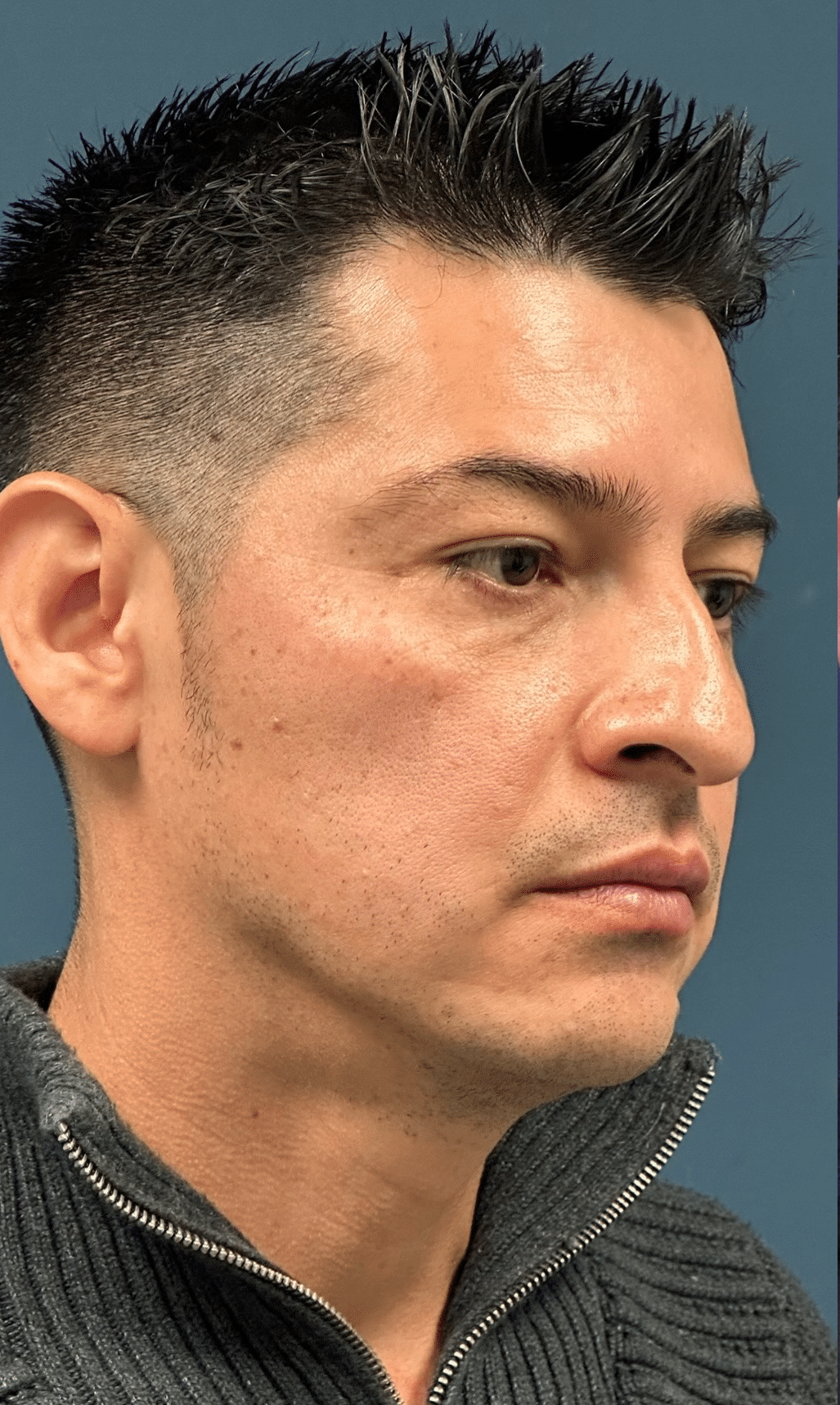 Before Image: Rhinoplasty with Nostril Narrowing and Upper Eyelid Lift - front