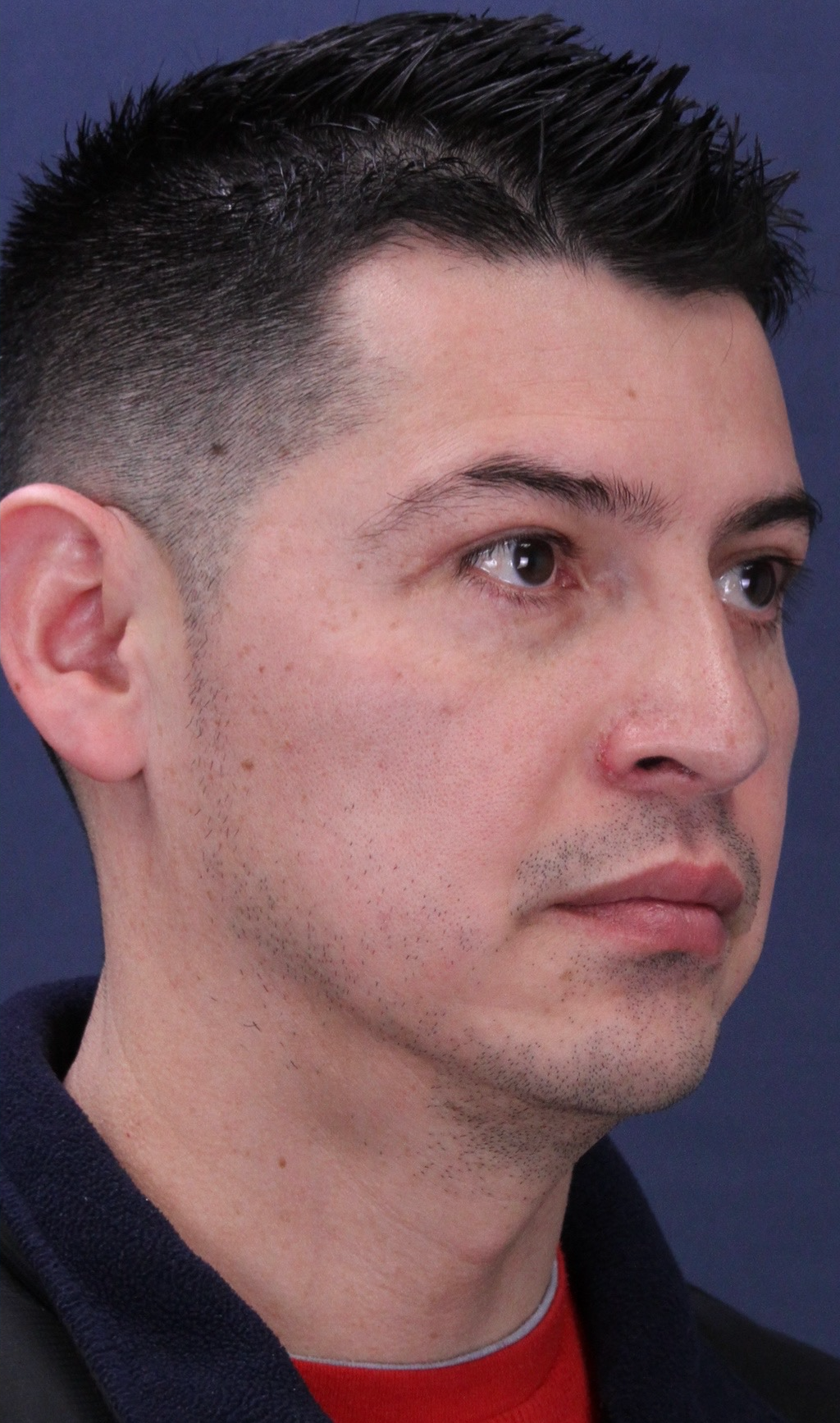 After Image: Rhinoplasty with Nostril Narrowing and Upper Eyelid Lift - front