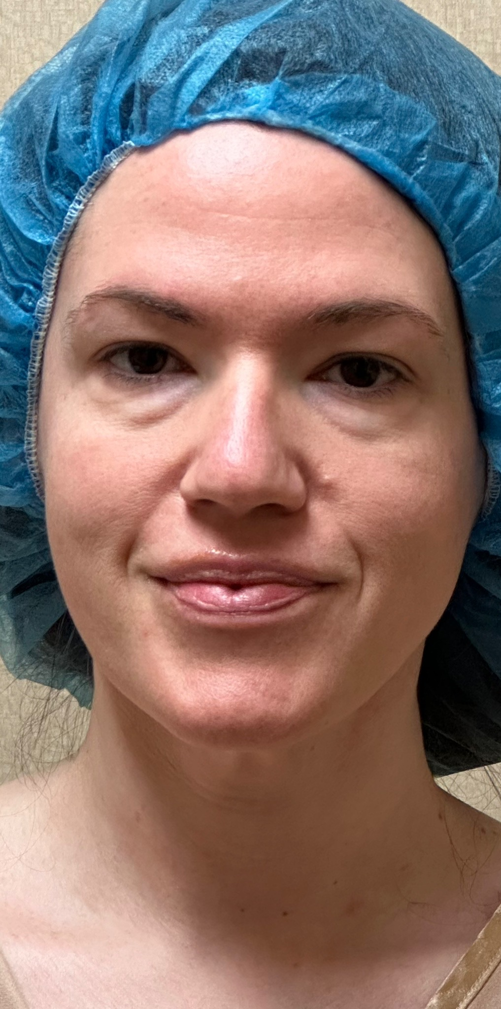 Before Image: MyEllevate Neck Lift,  Lower Eyelid Lift and Facial Fat Grafting - front