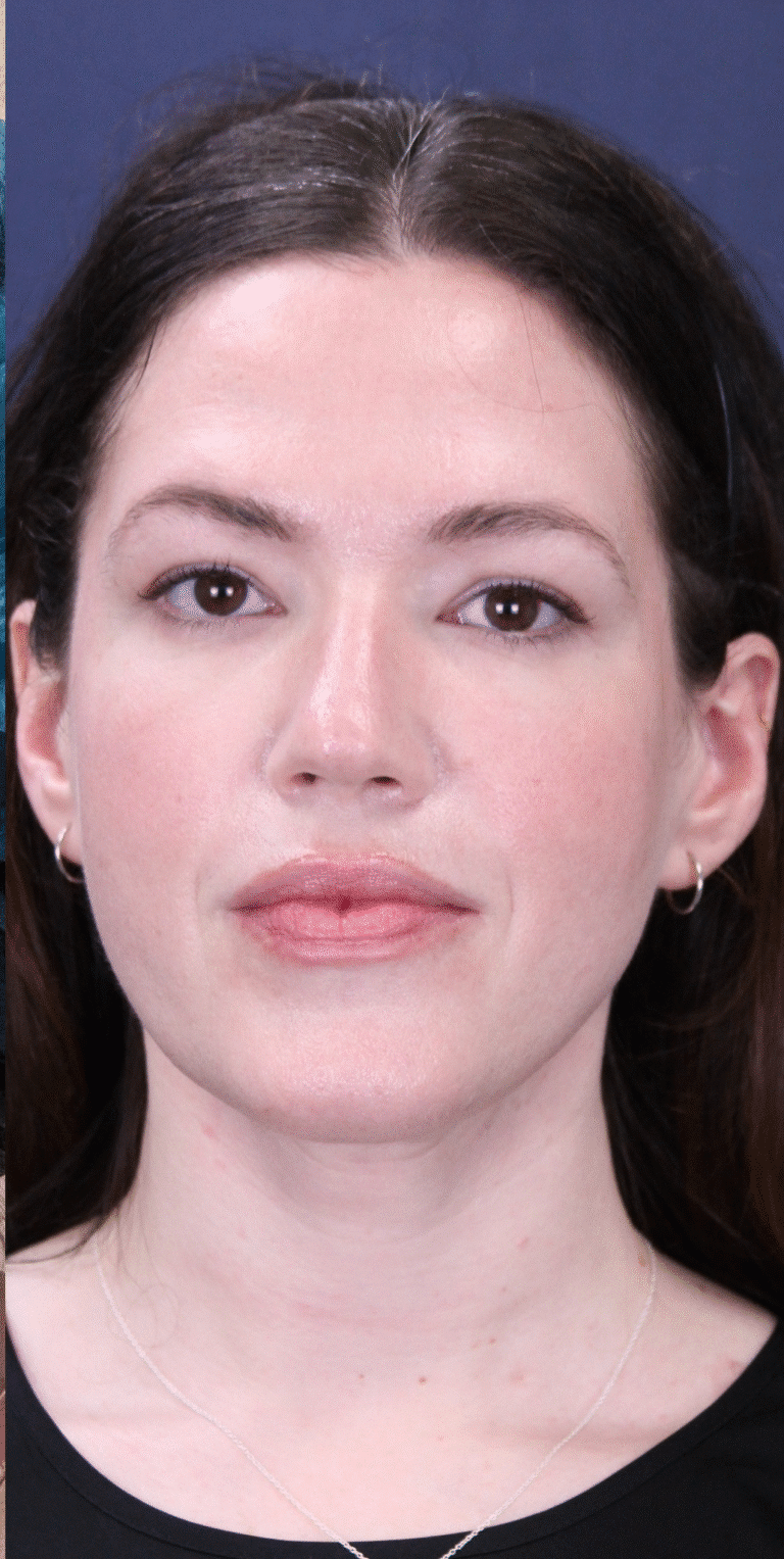 After Image: MyEllevate Neck Lift,  Lower Eyelid Lift and Facial Fat Grafting - front