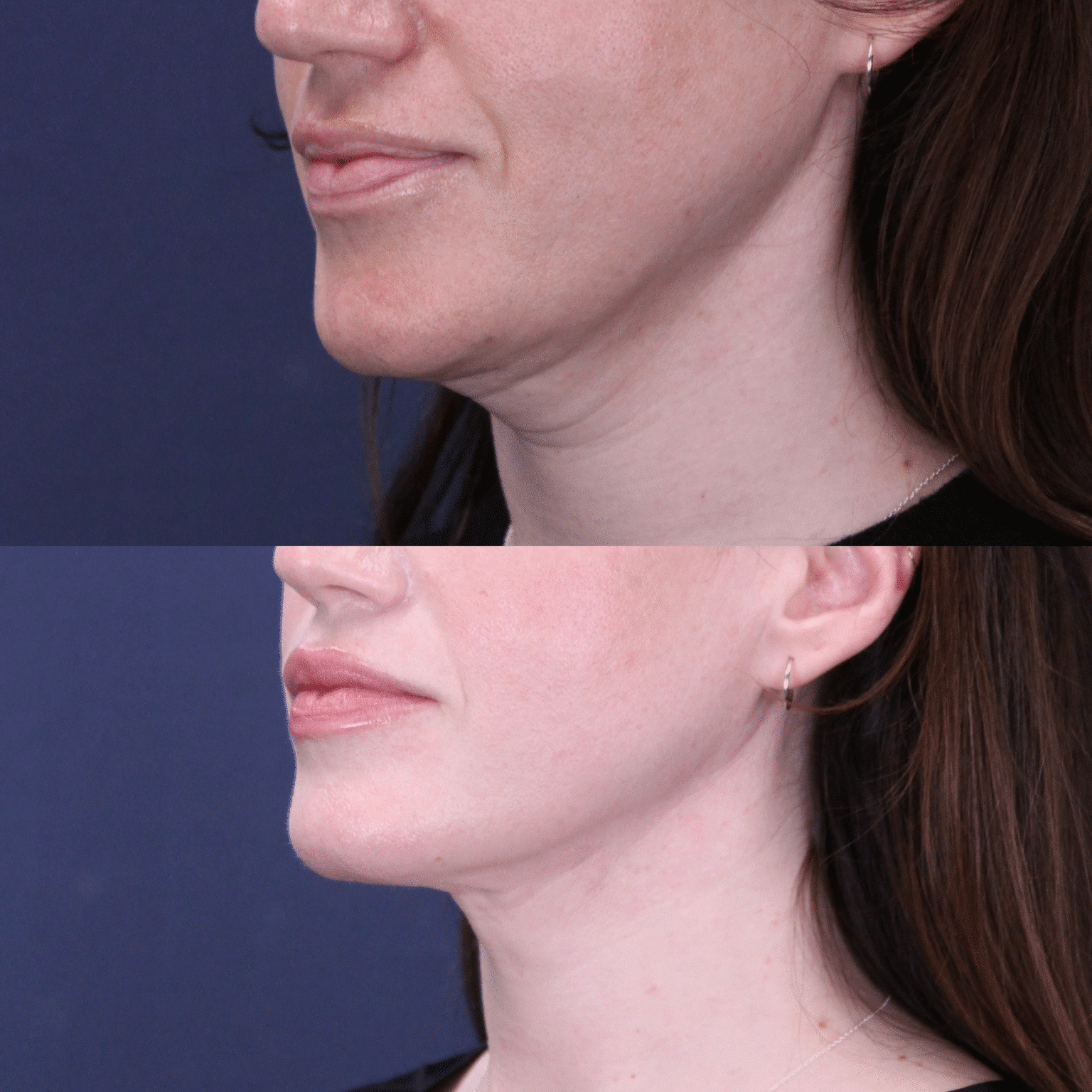 Case10 left angle neck