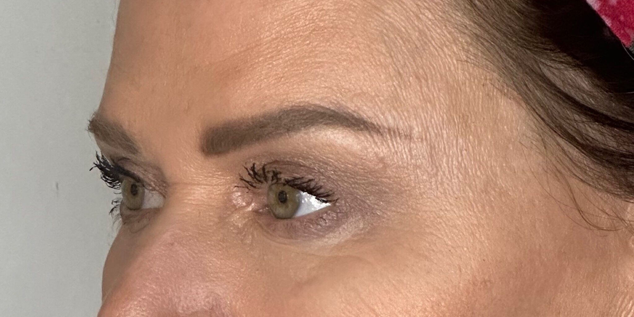 After Image: Upper and lower Bleph, lower eyelid laser - front