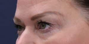 Before Image: Upper and lower Bleph, lower eyelid laser