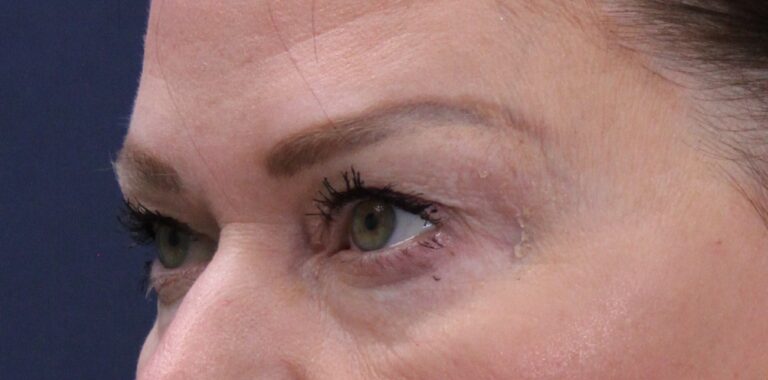 Before Image: Upper and lower Bleph, lower eyelid laser - front