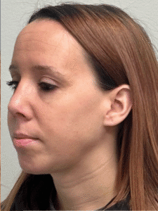 After Image: Rhinoplasty and Chin Implant