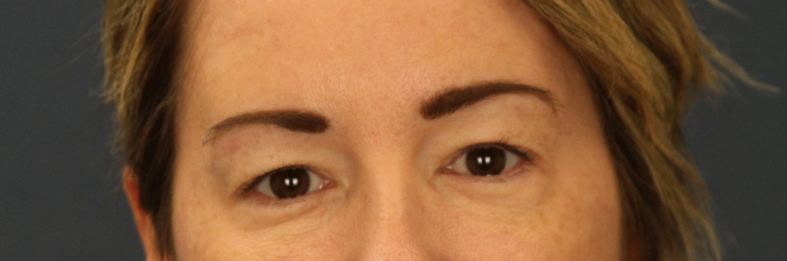 Before Image: Upper Blepharoplasty - front