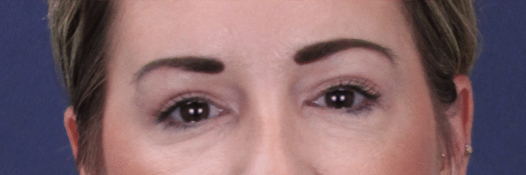 After Image: Upper Blepharoplasty - front