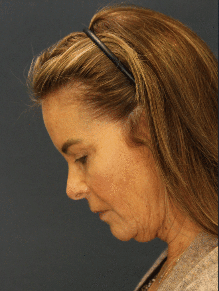 Before Image: Deep Plane Face and Neck lift with Platysmaplasty, Lip lift, Brow Lift, Facial Fat Grafting - left-side