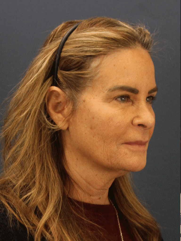 Before Image: Deep Plane Face and Neck lift with Platysmaplasty, Lip lift, Brow Lift, Facial Fat Grafting - right-front-oblique