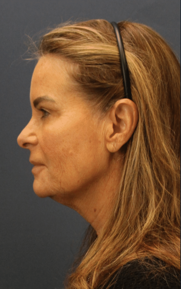 Before Image: Deep Plane Face and Neck lift with Platysmaplasty, Lip lift, Brow Lift, Facial Fat Grafting - left-side
