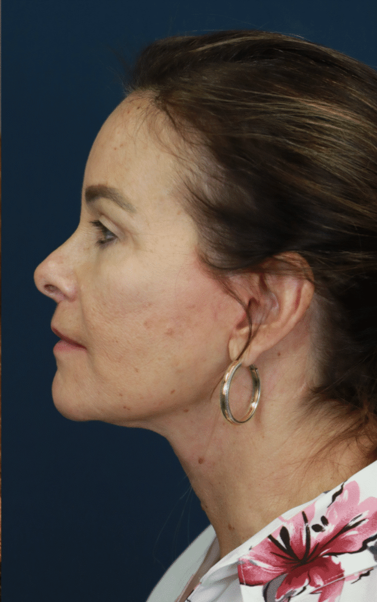 After Image: Deep Plane Face and Neck lift with Platysmaplasty, Lip lift, Brow Lift, Facial Fat Grafting - left-side