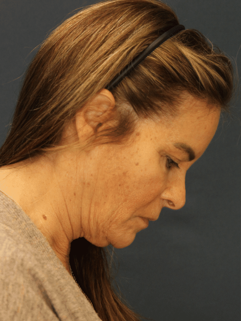 Before Image: Deep Plane Face and Neck lift with Platysmaplasty, Lip lift, Brow Lift, Facial Fat Grafting - other