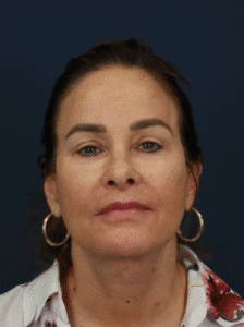 After Image: Deep Plane Face and Neck lift with Platysmaplasty, Lip lift, Brow Lift, Facial Fat Grafting